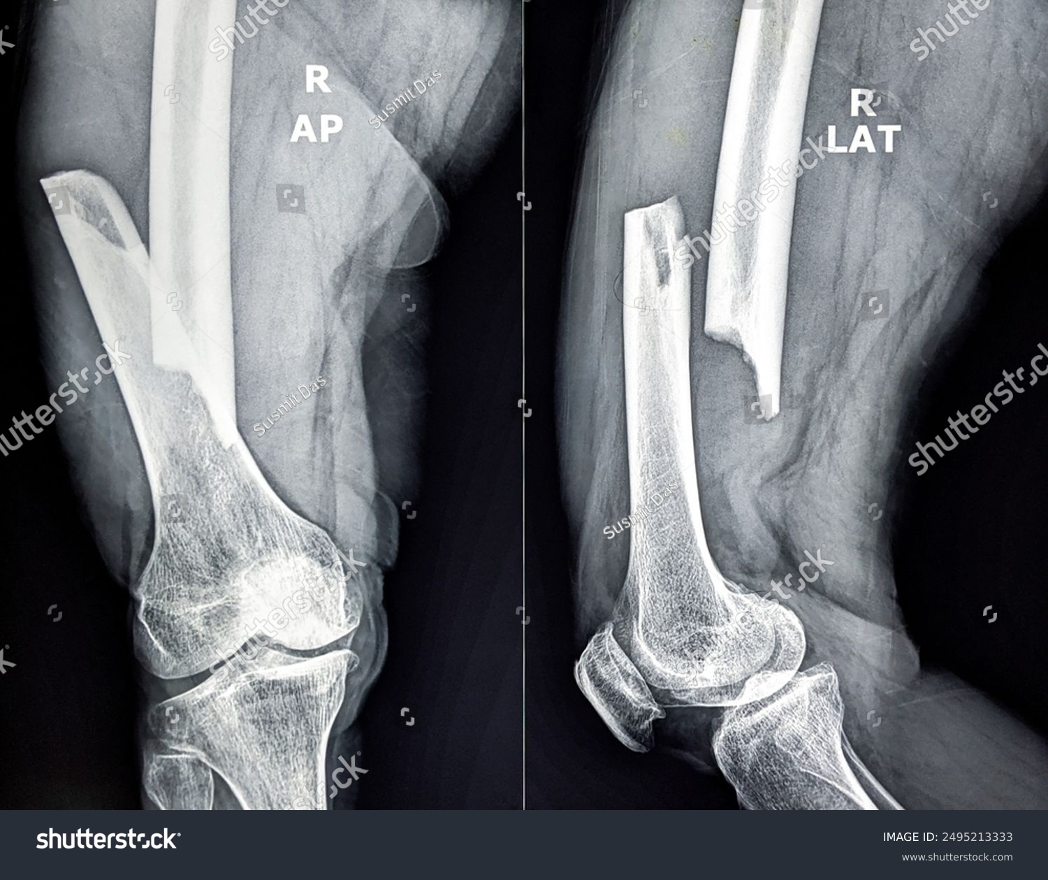 stock-photo-xray-image-of-femur-fracture-2495213333.jpg