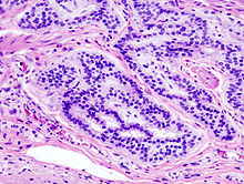 adenocarcinoma_histopathology.jpg