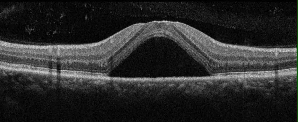 diabetic macular edema.png