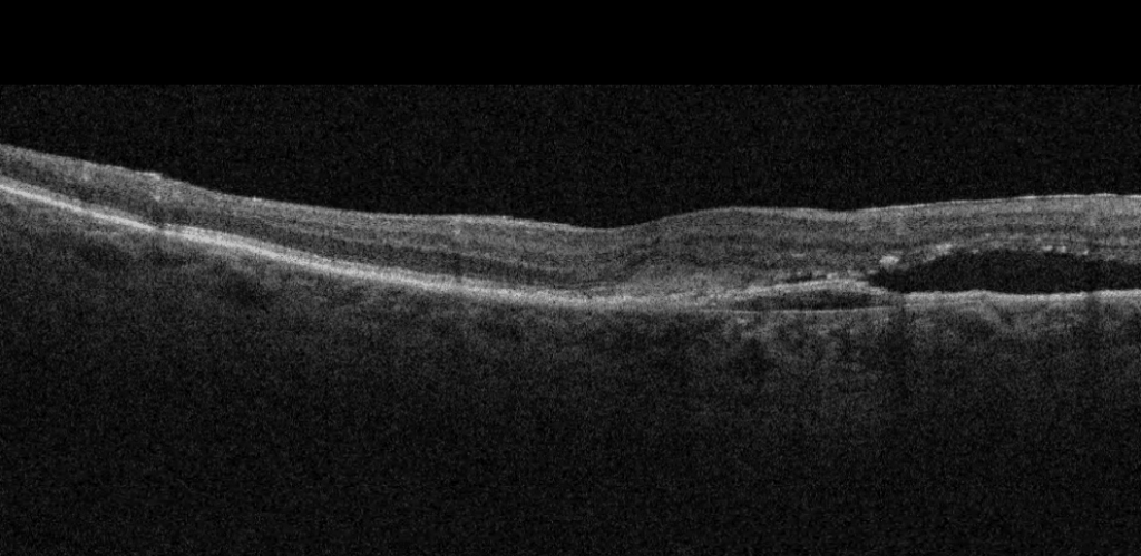 choroidal neovascularization.png