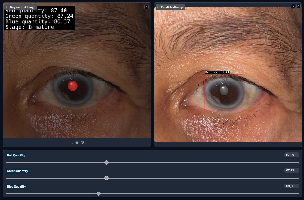 Cataract Analyzer