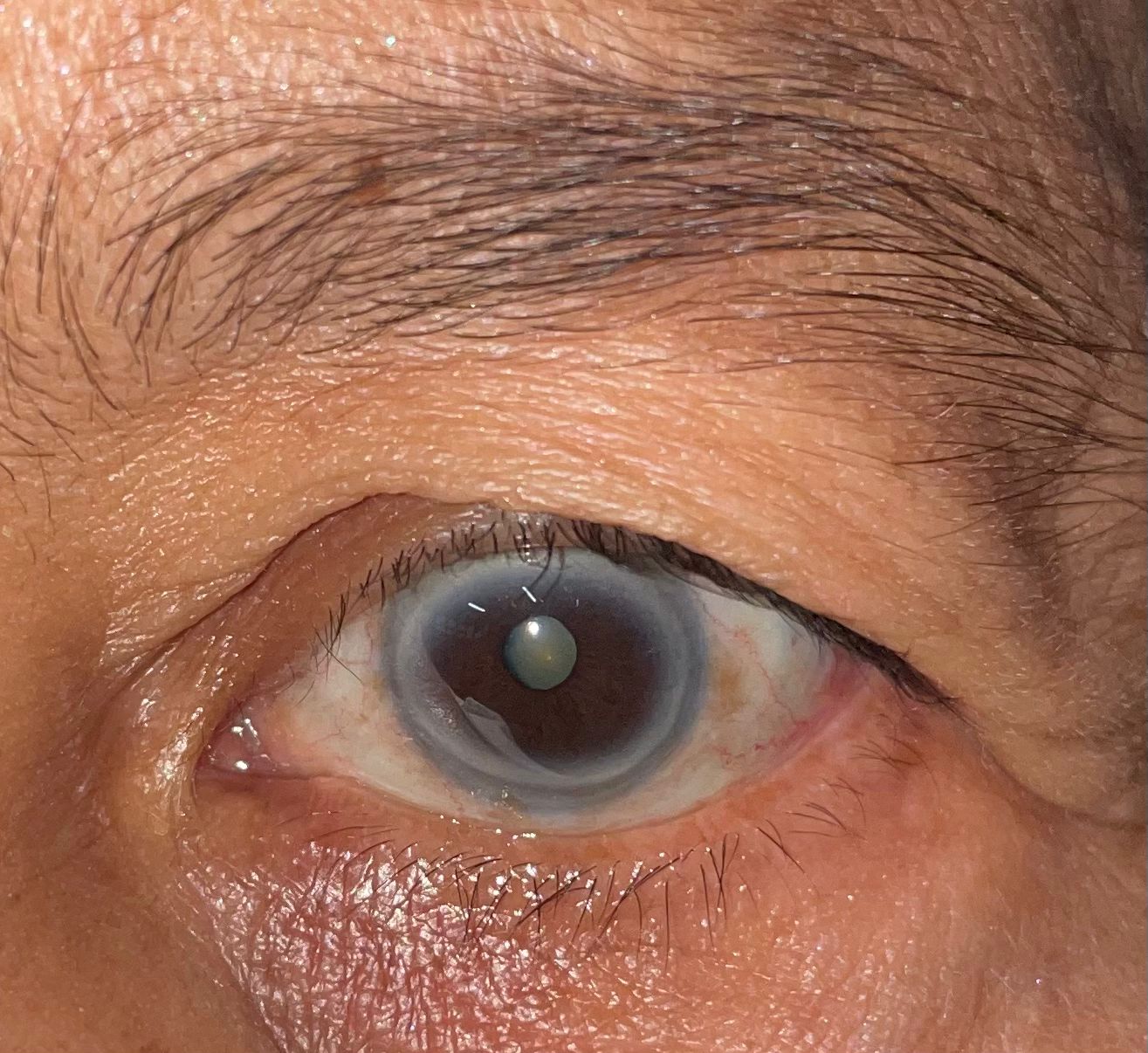 test-cataract-image.jpg