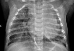 pneumonia.jpeg