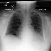 chestxray1.jpg