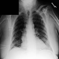 chestxray2.jpg