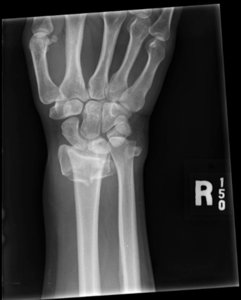 distal_radius.jpg